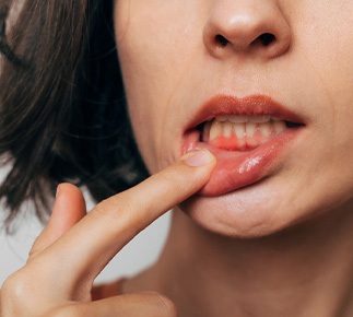 Woman with gum irritation