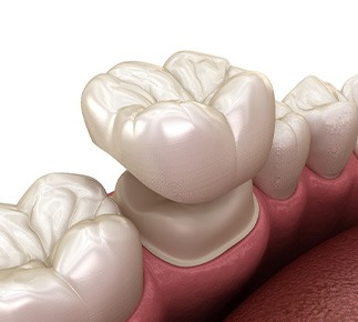 Illustration of dental crown being placed on prepared tooth