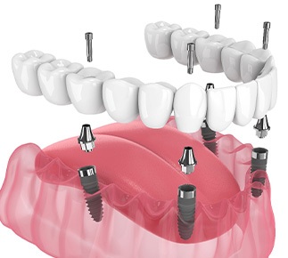 Illustration of an implant denture
