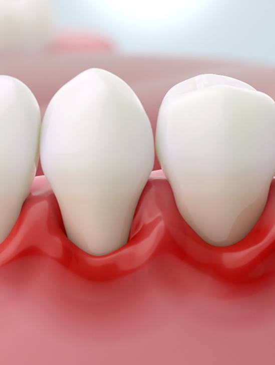 Illustration of red, inflamed gums