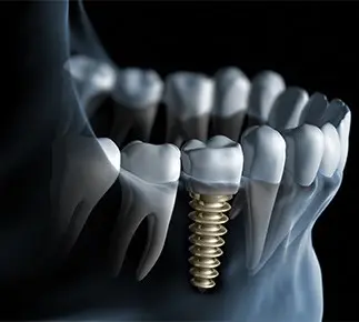 Illustration of dental implant inserted into jawbone