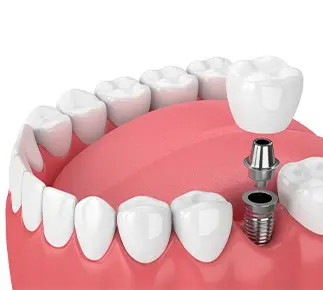 Illustration of dental implant, post, and crown being placed in lower arch